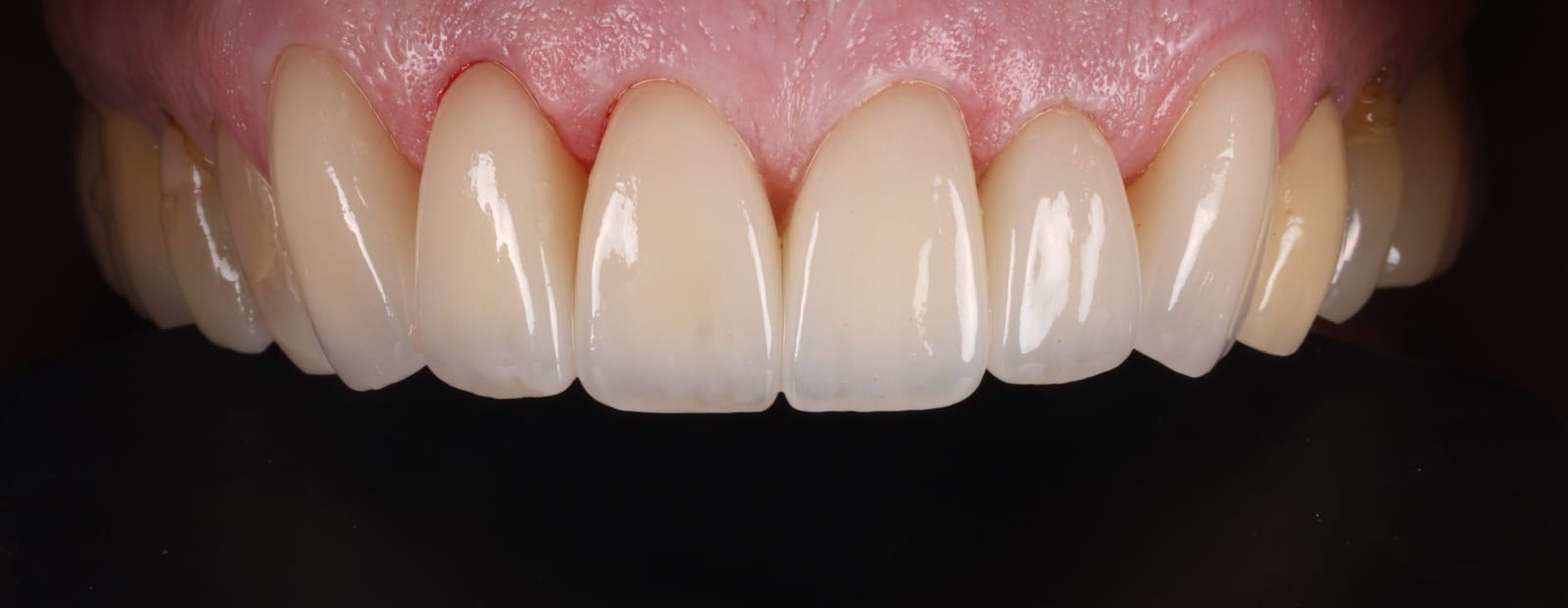 Upper anterior ceramic crowns photographed intraorally, showing the crown margins where they meet the gingiva.