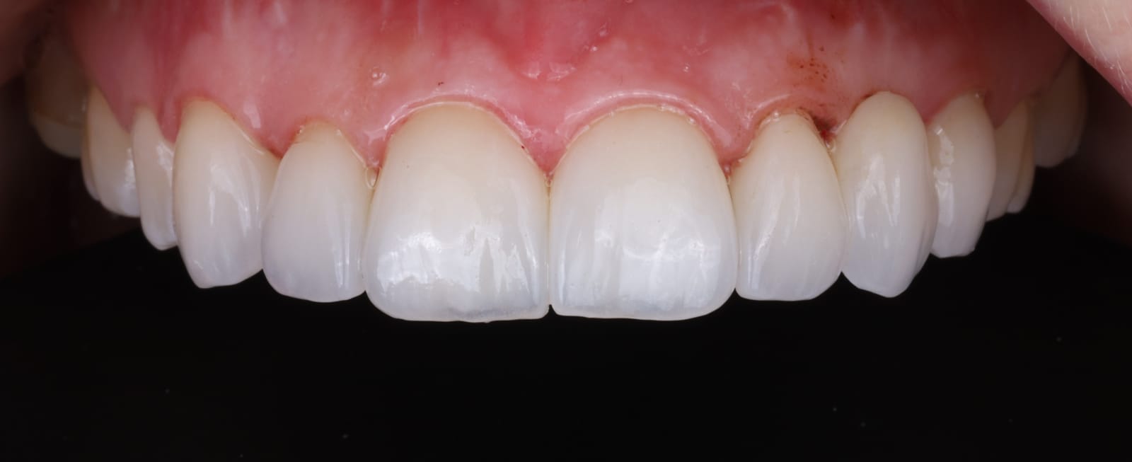Upper anterior ceramic crowns photographed intraorally against a black contrastor, showing the incisal edges and gingival margins.