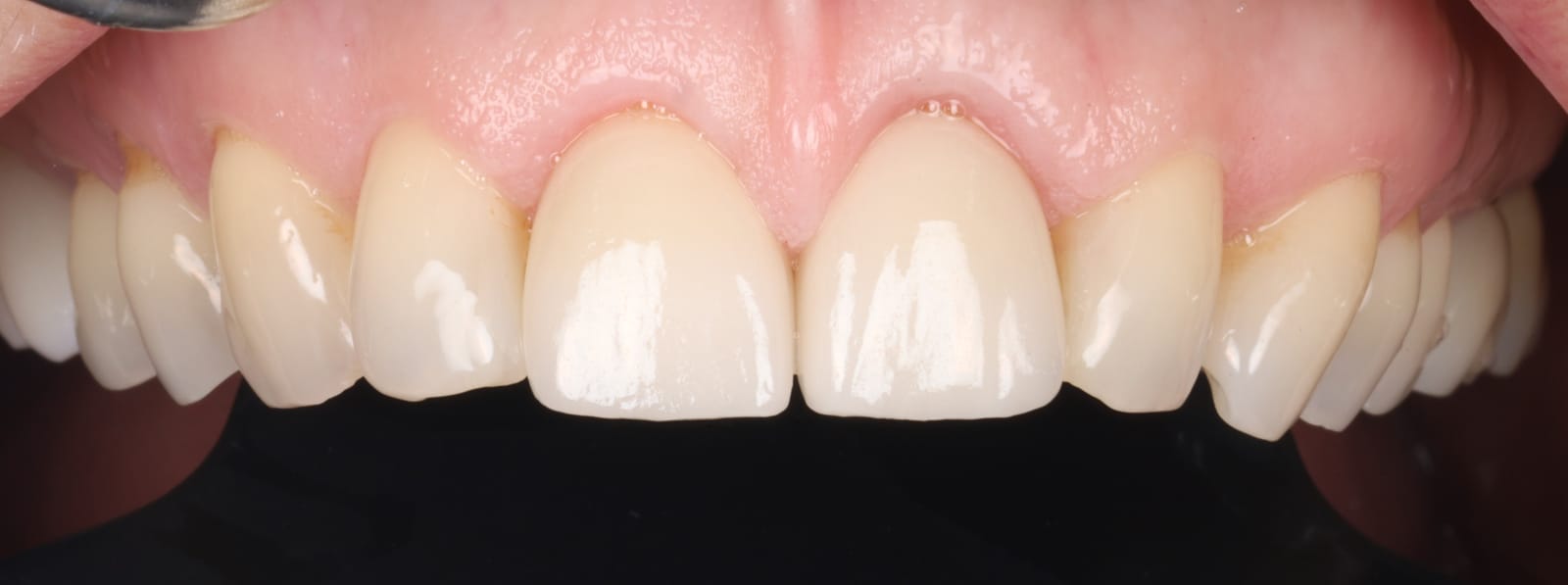 Upper anterior ceramic crowns photographed intraorally against a black background, showing shade and surface texture.
