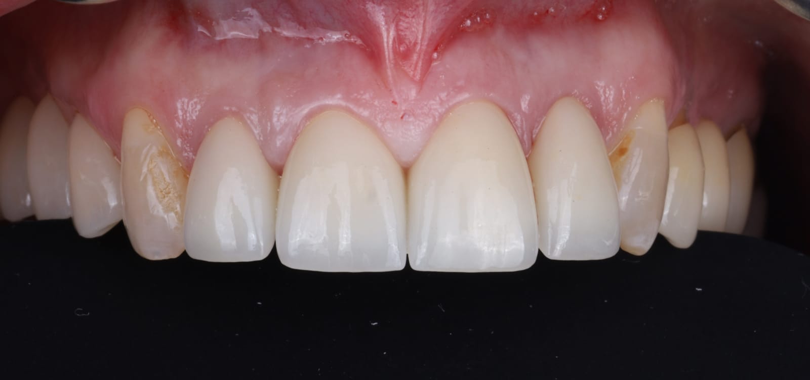 Upper anterior ceramic crowns photographed intraorally, showing the width to height proportion of the front teeth.