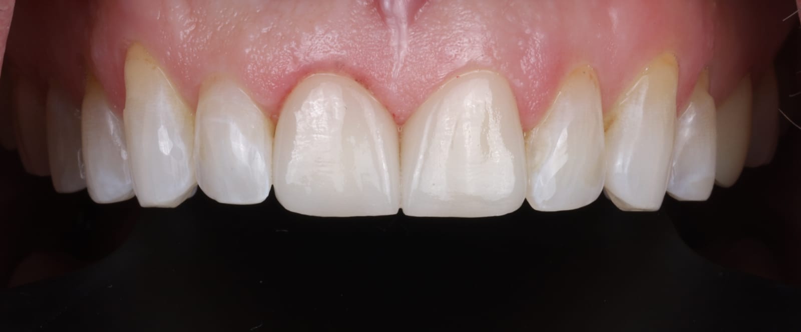 Ceramic crowns seated on the upper front teeth, photographed intraorally with the lip retracted.