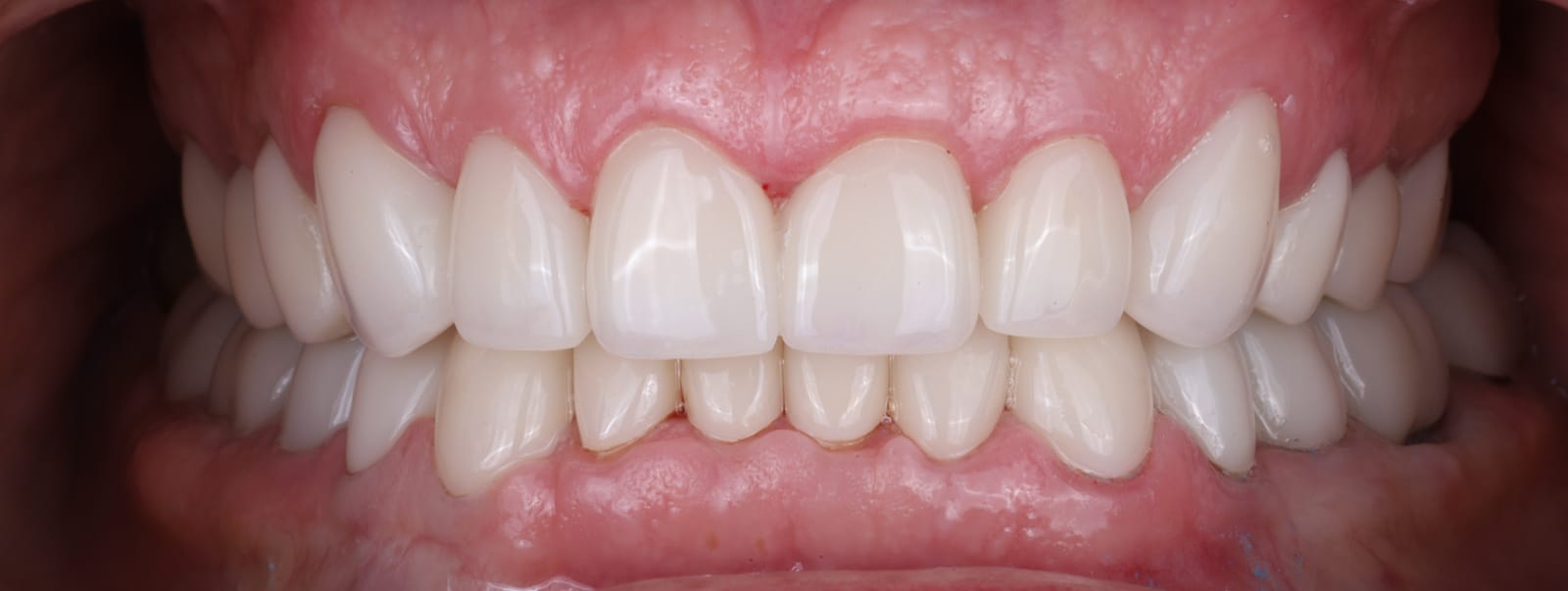 Upper and lower anterior ceramic crowns in occlusion, photographed intraorally with the lips retracted.