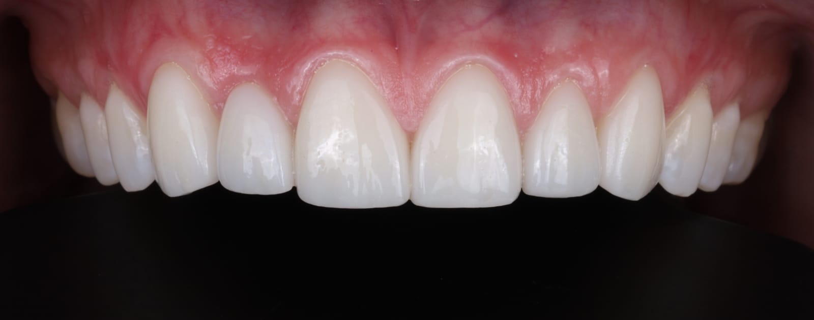 Esthetic porcelain veneers on the upper front teeth photographed intraorally against a dark background, showing the incisal edges.