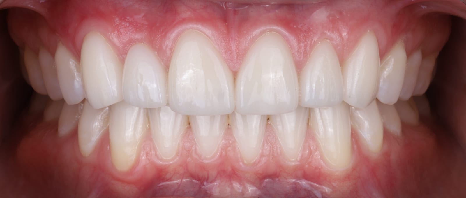 Esthetic veneers on the upper and lower teeth photographed intraorally in occlusion, with the lips retracted.