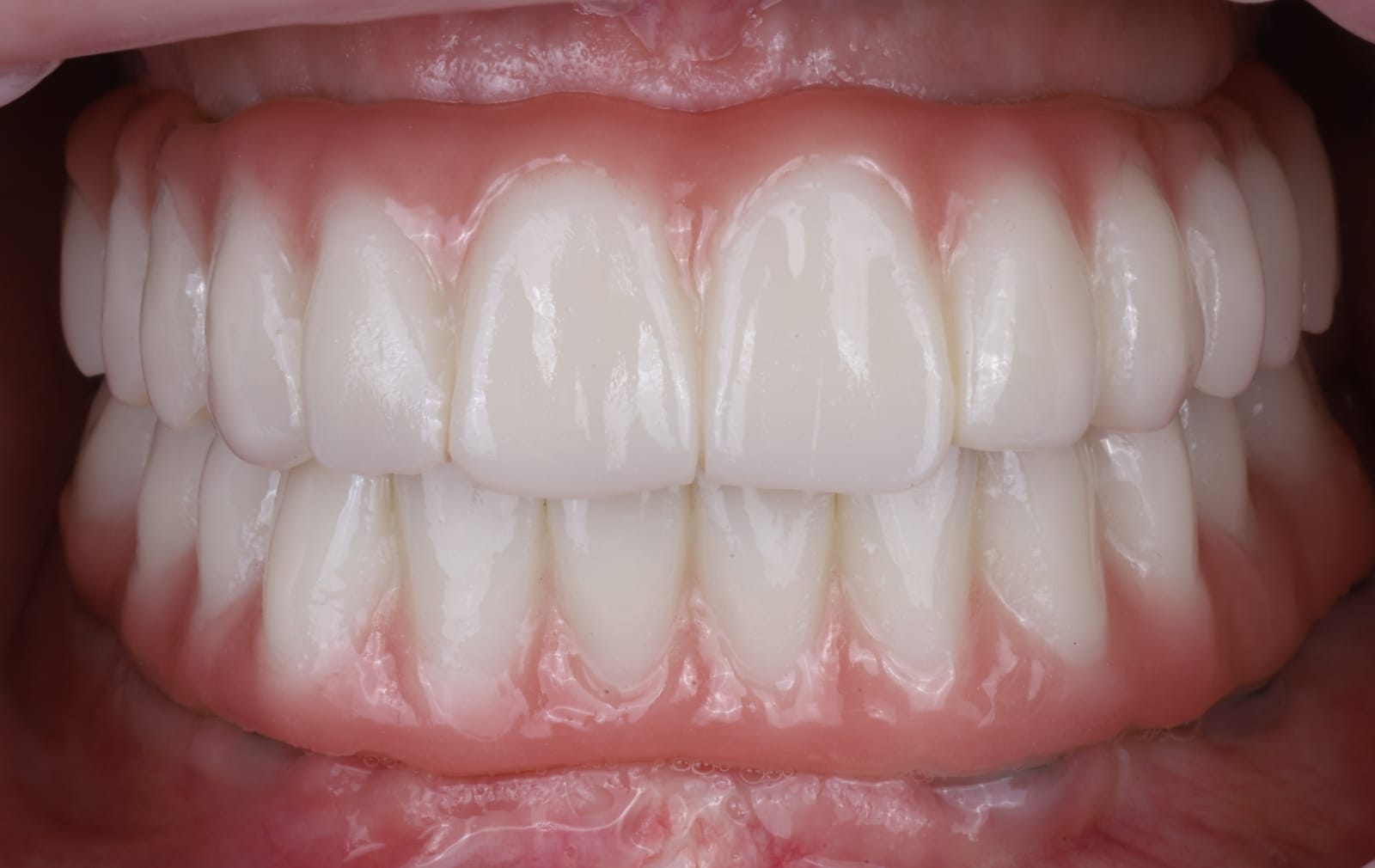 Upper and lower full arch implant supported fixed dental prostheses in occlusion, photographed intraorally with the lips retracted.