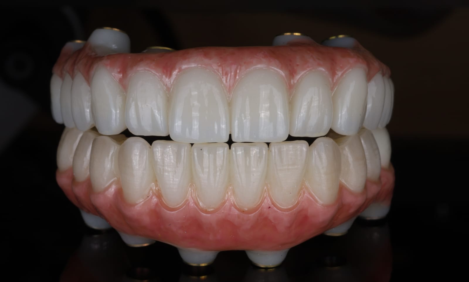 Full mouth implant supported fixed dental prosthesis, upper and lower arches together, photographed on black with gingival coloured ceramic and titanium cylinders.