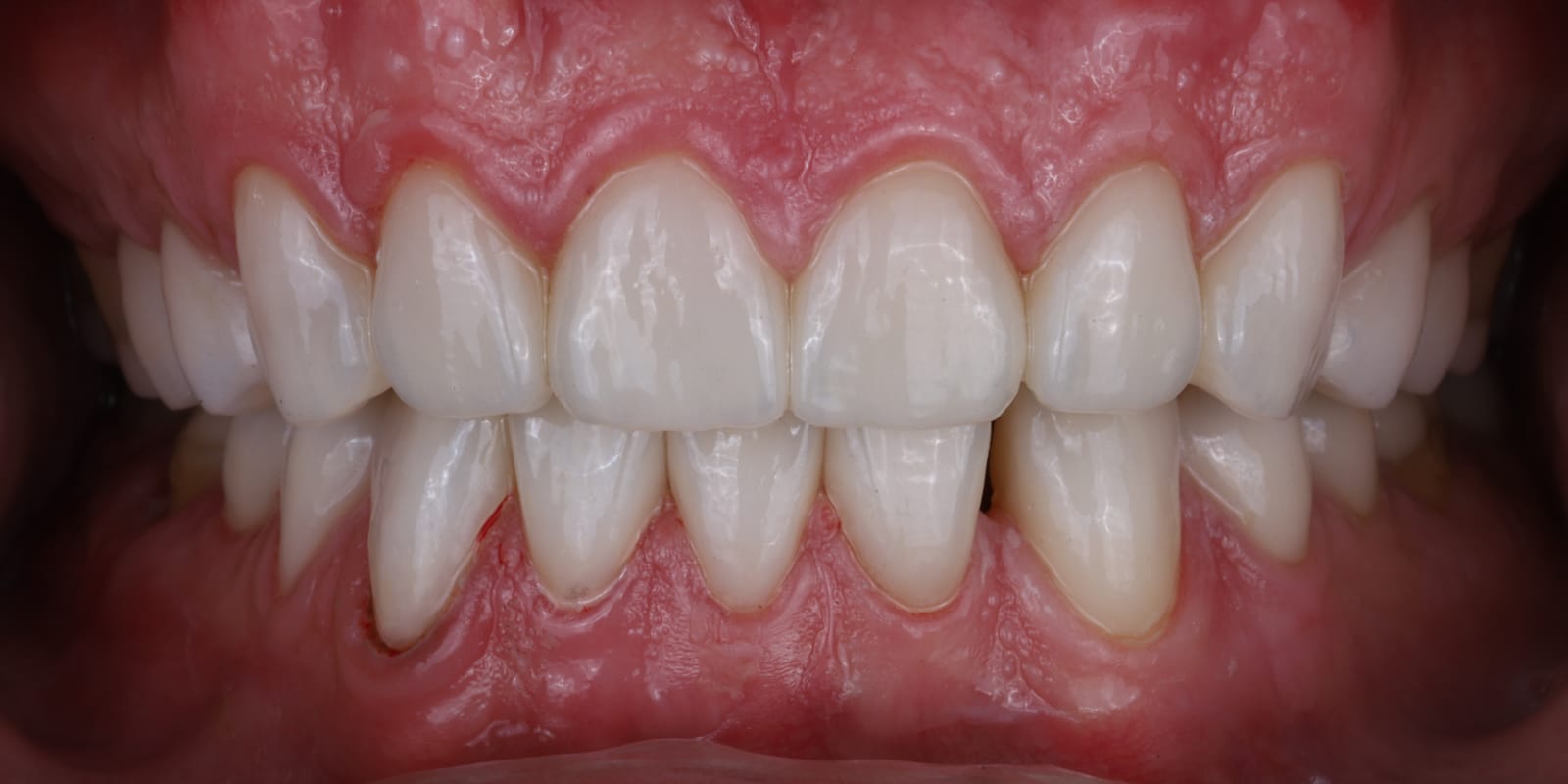 Full mouth rehabilitation with ceramic crowns on the upper and lower teeth, photographed intraorally in occlusion.