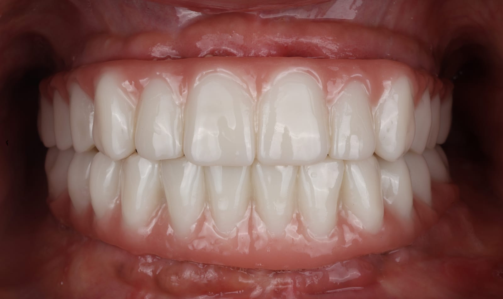 Full arch implant supported fixed dental prostheses in occlusion, photographed intraorally with the lips retracted.