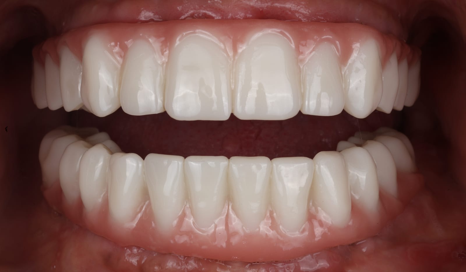 Upper and lower implant supported fixed dental prostheses photographed slightly apart, showing the incisal edges of the anterior teeth.