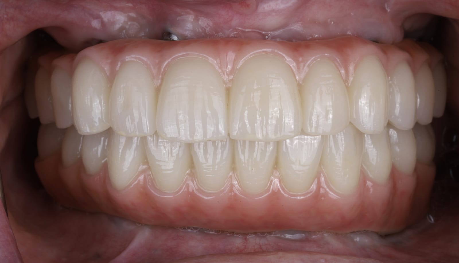 Upper and lower implant supported fixed dental prostheses in occlusion, photographed intraorally with the lips retracted.