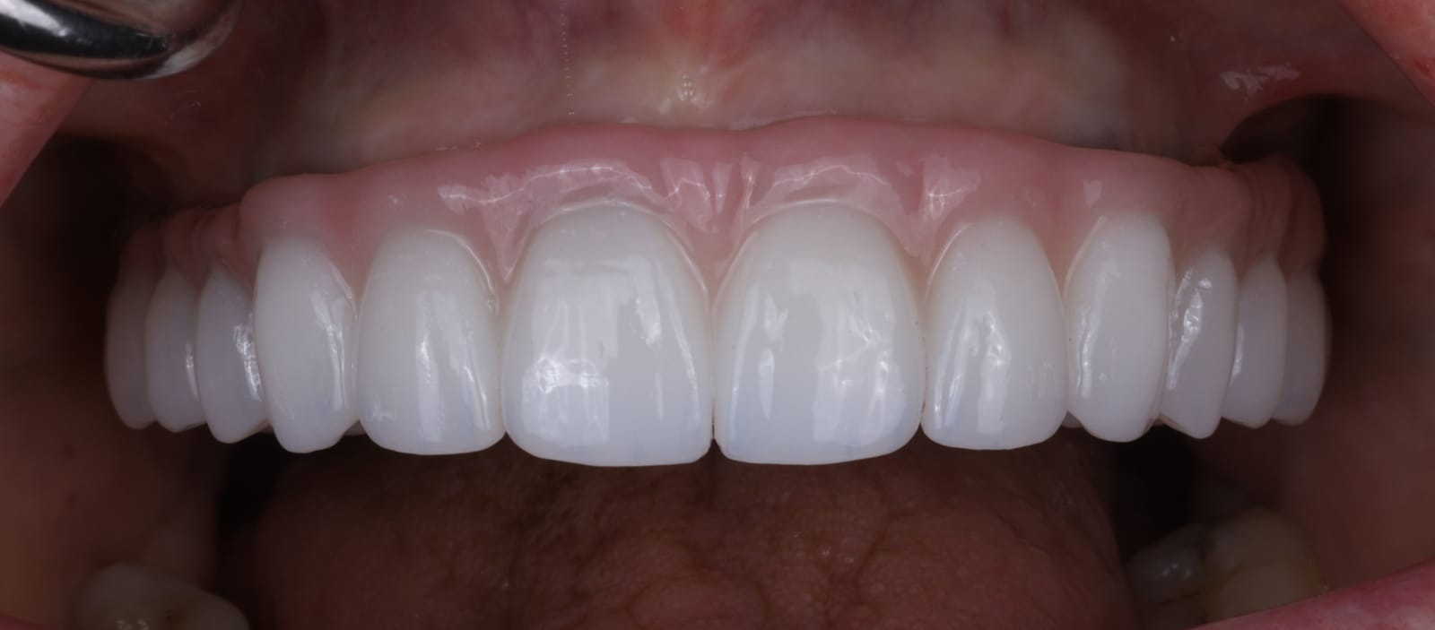 Upper implant supported fixed dental prosthesis seated in the mouth, photographed with the lips retracted so only teeth and gingiva are in frame.