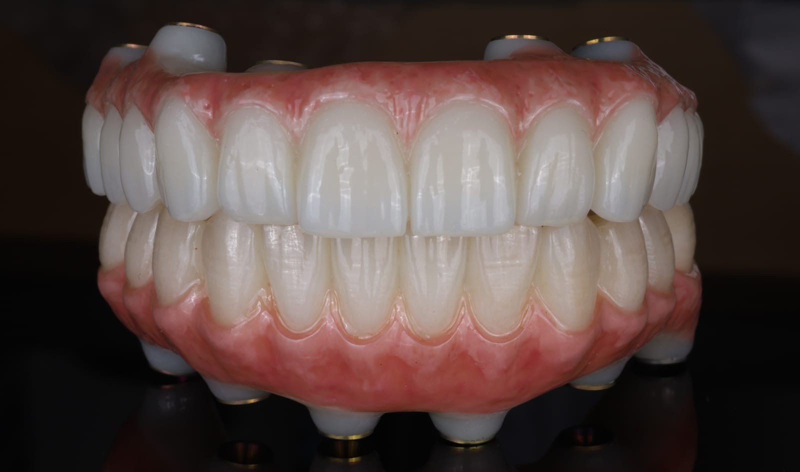 Upper and lower implant supported fixed dental prostheses in occlusion, photographed on a black reflective surface with the titanium abutment cylinders visible.
