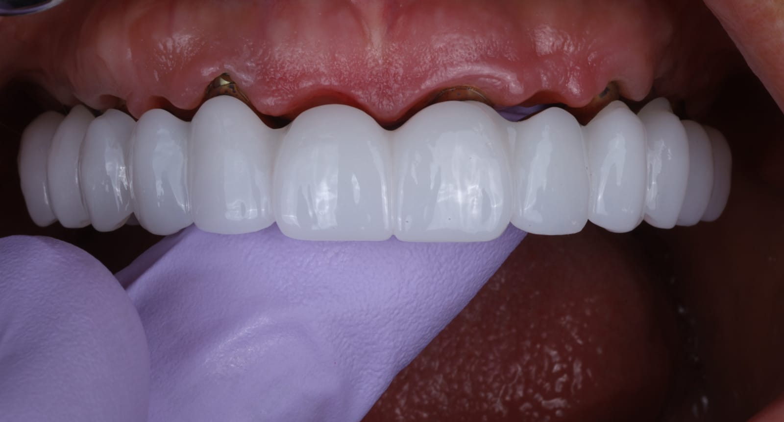 Upper implant supported fixed dental prosthesis seated in the mouth, photographed with the lip retracted to show the gingival margin.