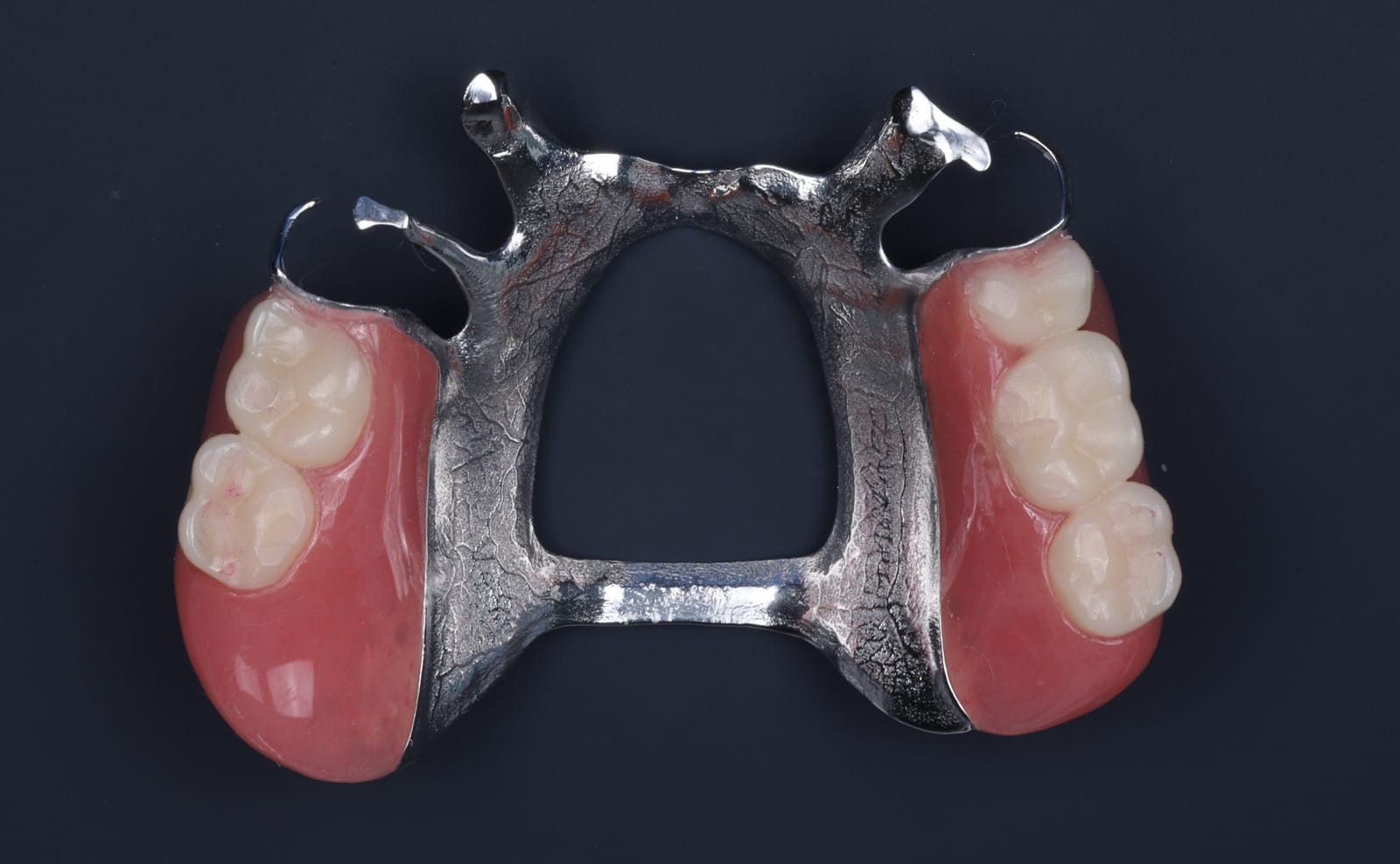 An upper removable partial denture with a cast metal framework, clasps and acrylic saddles carrying the replacement teeth.